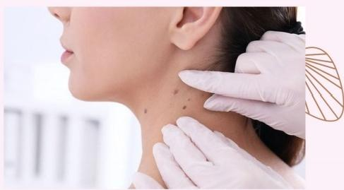 SKIN TAG REMOVAL $18 $38 $98